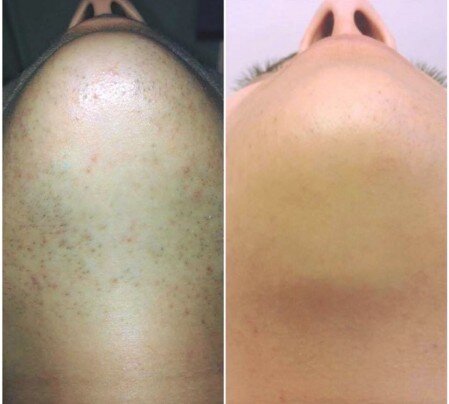Bastapeli Prima e Dopo laser mento prima e dopo