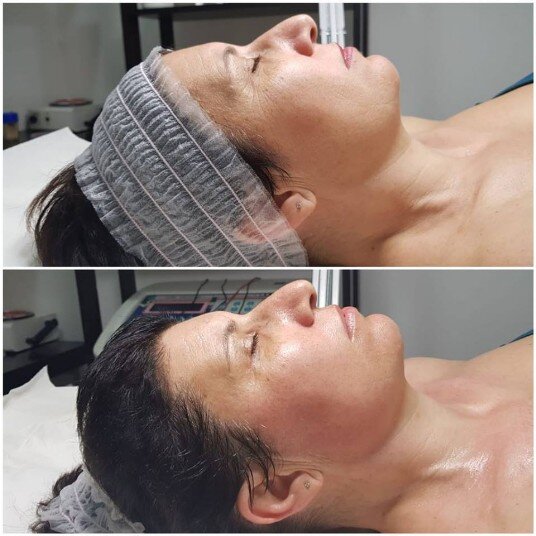 prima e dopo rughe trattamento rughe