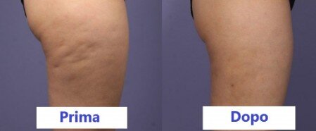 cellulite ritenzione idrica