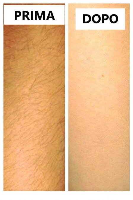 BastaPeli prima e dopo laser prima e dopo