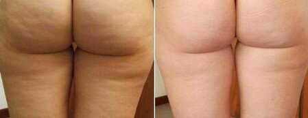 Cellulite Cellulite trattamento corpo
